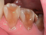 Fig 4. Severe buccal erosion, Nos. 28 and 29. Note shadow of pulp chambers.