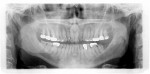 Fig 7. Panoramic radiograph taken in 2017. Note increased occlusal erosion of tooth No. 18.