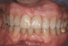 Fig 6. 17-year-old female with missing tooth No. 7 and intact adjacent teeth.