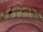 Fig 12. Post-orthodontic treatment showing overbite and improved midline.