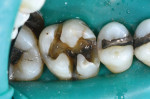 Occlusal view of a first molar after removal of a failing mesial-occlusal-lingual amalgam restoration showing signs of dentin cracks.