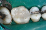 Occlusal view of the final layer of the hybrid composite, which was placed and cured at once using the laser curing light.