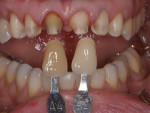 Figure 6  Stump shade communication photos. Tooth preparation was heavy due to the uneven value and chromatic nature of the tooth stumps.