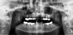 Pretreatment panoramic radiograph showing the two-plane occlusion.