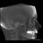 Pretreatment right profile patient portrait and pretreatment cephalometric radiograph showing a lack of lower lip support and a Class II dental and skeletal relationship.