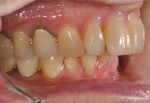 Pretreatment retracted righ and left lateral photographs showing the amount of overbite and overjet.