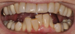 Pretreatment retracted photograph with the teeth apart showing the severe two-plane occlusion.