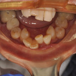 Pretreatment upper and lower occlusal view photographs showing the severe level of crowding, especially in the lower anterior region.