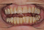Progress photograph acquired after 6.5 months of clear aligner treatment demonstrating that the lower anterior teeth had been intruded by approximately 6.6 mm.