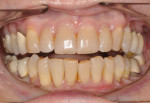 Posttreatment retracted photograph with the teeth apart showing the leveling of the occlusal plane and differential intrusion of teeth Nos. 24 and 25 in preparation for restoration to cover exposed dentin.