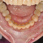 Posttreatment upper and lower occlusal view photographs. Note the lingual wire that was placed in the lower anterior region for retention.