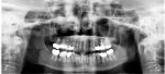Posttreatment panoramic radiograph demonstrating that the lower anterior teeth were intruded by approximately 8 mm. Note the slight root blunting of the lower anterior teeth that occurred as a result of their intrusion.