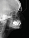Posttreatment cephalometric radiograph showing increased proclination of the lower anterior teeth.