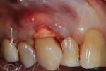 The hydrated ADM was inserted underneath the mucogingival flap and secured using a continuous 4.0 PTFE suture.