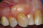 At the 6-week follow-up, the tooth No. 6 site showed complete root coverage. Note the visible borders of the hydrated ADM.