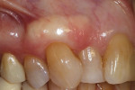At the 19-week follow-up, the tooth No. 6 site still demonstrated complete root coverage, and there were no visible changes in the dimensions of the graft.