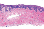 The H&E-stained biopsy from the ungrafted site showing collagen fibers aligned horizontally and mostly parallel to the superficial epithelium.