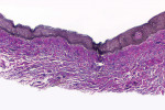 The Verhoeff’s-stained biopsy from the ungrafted site showing parallel collagen with an absence of elastin fibers.