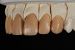 Figure 10  Changes in the wax were made based on examination of the photos of the provisional restorations, the doctor’s requests from the lab slip, and instructions in the PowerPoint presentation.