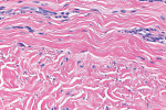 Close-up view of the H&E-stained biopsy from the grafted site showing the distinct border between the native tissue with parallel collagen fibers and the incorporated hydrated ADM with disorganized collagen fibers.