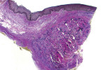 The Verhoeff’s-stained biopsy from the grafted site showing the native tissue collagen with an absence of elastin fibers overlying the incorporated hydrated ADM with an abundance of darkly stained elastin fibers.
