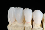 Figure 12  Incisal cutback was refined to imitate internal lobe formation prior to color modification.