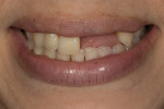 Fig 1. Pretreatment frontal view of patient smiling.