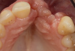 Fig 2. Pretreatment occlusal view of maxillary anterior defect.