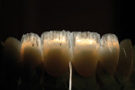 Figure 16  Backlighting of the build-up shows the variations of translucency of the effect porcelains.