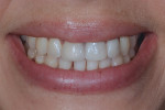 Fig 12. Post-treatment frontal view of patient smiling.