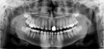 Fig 1. Panoramic radiograph showing tooth No. 18 with immature root formation and an open apex.