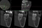 Fig 4. CBCT showing extension of radiolucency from the alveolar crest to root apices.