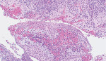 Fig 5. Histological specimen showing the connective tissue wall lined by non-keratinized stratified squamous epithelium.