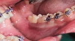 Fig 6. Preoperative view of tooth No. 18 showing inflammation of buccal gingiva.