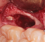 Fig 8. Extent of the bony defect was clearly visible.