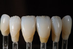 Figure 17  Once fired, these effects can be evaluated and modified as desired, prior to finishing the full-contour build-up of the incisal area.