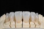 Figure 18  Once satisfied with the translucency and color pattern in the incisal, an appropriate enamel powder is used to accomplish the full contour.