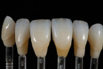 Figure 22  Front lighting shows the dynamic incisal effects possible with a micro-layered approach.