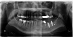 Figure 13  Preoperative panorex of nonrestoreable tooth No. 19 and site No. 18.