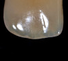 Figure 10  Final restoration with porcelain-fused-to-metal (PFM) crown on tooth No. 8.