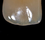 Figure 28  Opalescence causes tooth enamel to reflect blue light back to the observer.
