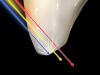 Figure 1  Soft tissues retracted with retraction cord.