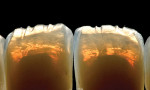 Figure 33  The technician created an internal angled surface at the incisal edge and interproximally with the pressed coping to scatter the red-yellows.