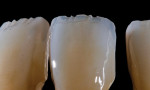 Figure 34  The technician created an internal angled surface at the incisal edge and interproximally with the pressed coping to scatter the red-yellows.