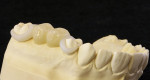 Figure 4  The first removable case made entirely using CAD/CAM technology, with IPS e.max crowns on an ABS 3-D printed framework.