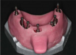 A custom tray designed for an open tray implant impression with holes to allow the emergence of the long pins of the open tray impression copings.