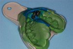View of the intaglio surface of the clear foil-covered tray shown in Figure 3 following attachment of the implant analogs to the captured open tray impression heads.