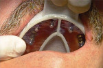 Try-in of a clear foil-covered open tray on the maxillary arch in preparation for an impression of five implants.
