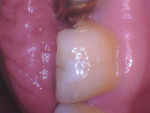 Pretreatment close-up occlusal, lingual, and buccal intraoral photographs of the mandibular left first molar, which experienced a fracture involving the loss of the distolingual cusp, starting at the lingual groove, that progressed from the distolingual cusp across the distal marginal ridge, resulting in partial loss of the distobuccal cusp.