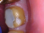 Close-up buccal and lingual photographs of the tooth after it was prepared and a buildup was performed. Note the chamfer margin that was created during preparation.